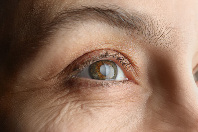 Closeup of a Cataract in an Eye