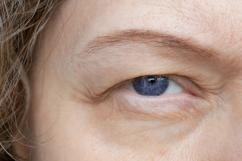 Closeup of someone with ptosis