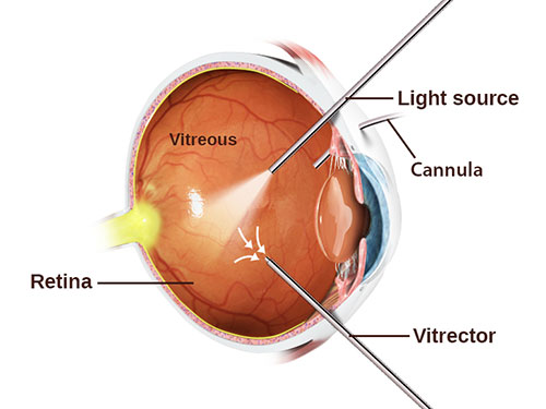 Vitrectomy Chart